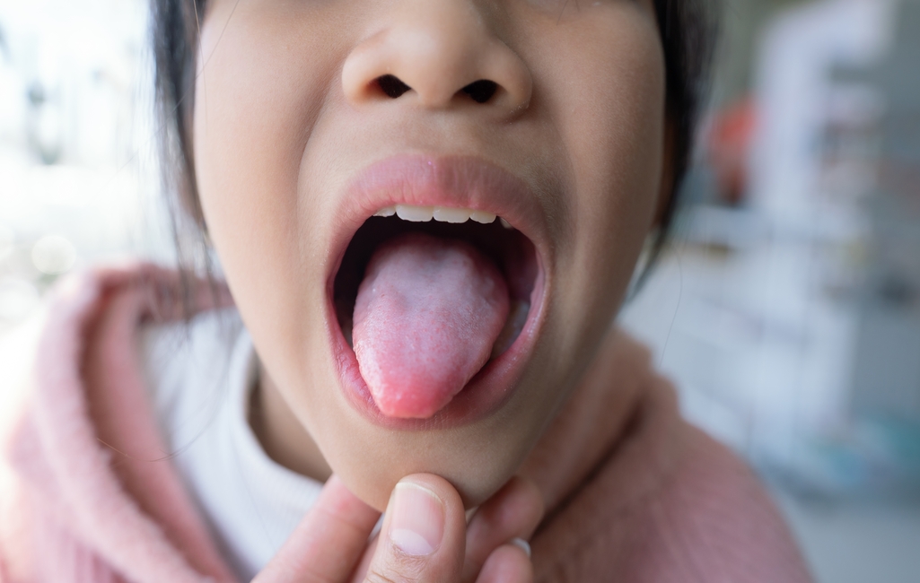 Right -up measles: watch out for signs in the mouth this oral sign monitor
